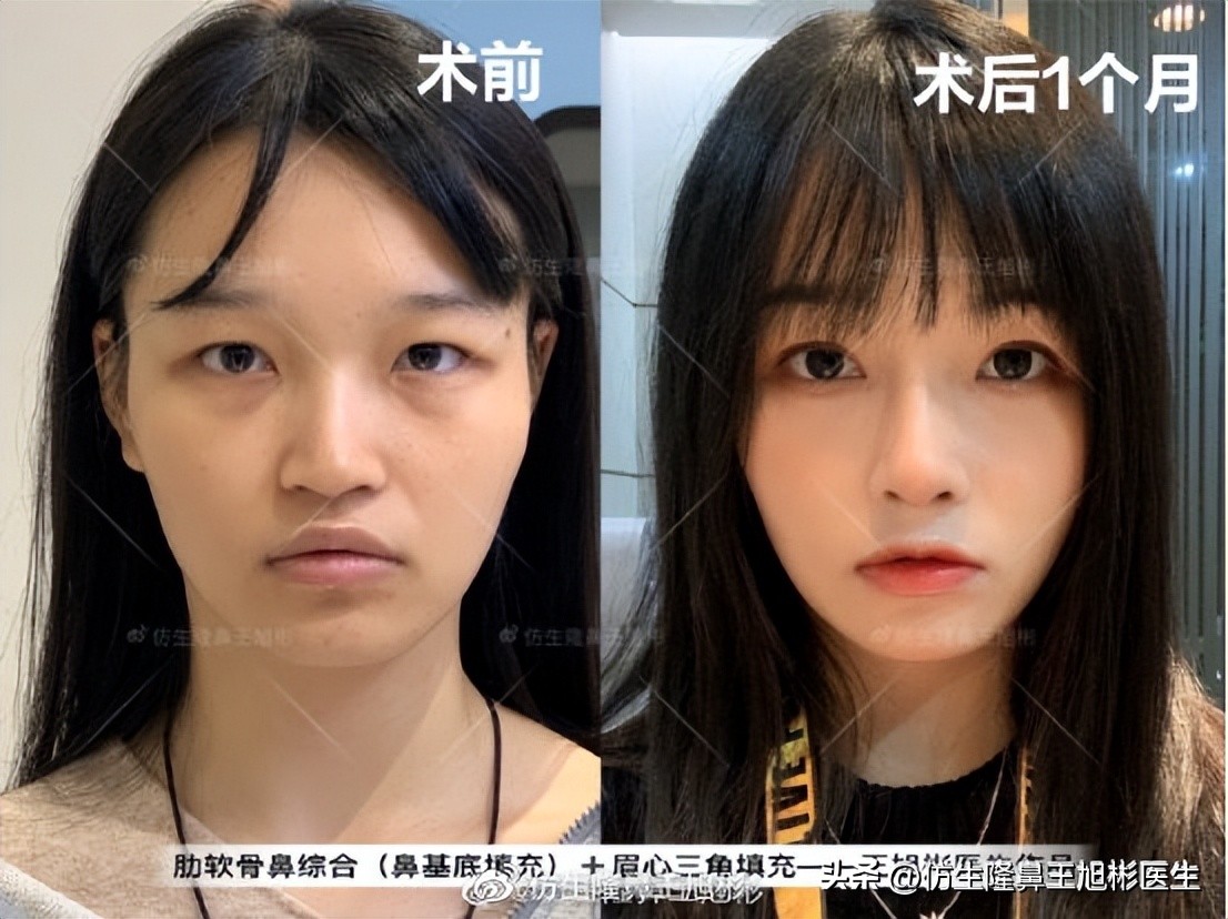 鼻翼缩小可以改善鼻翼缘后缩吗,鼻翼肥大如何正确改善