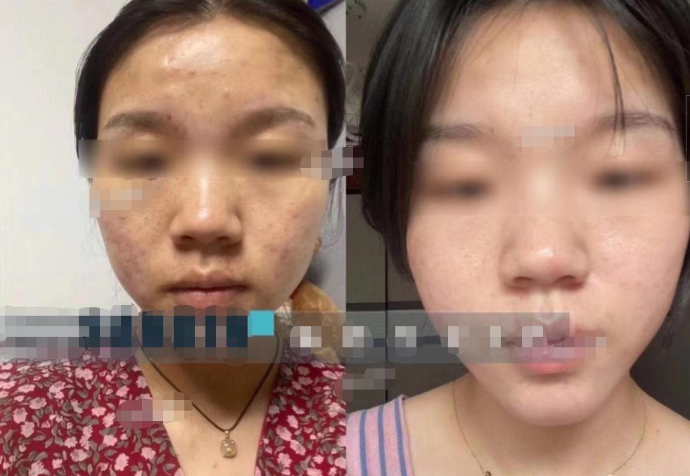 睡前怎样保养皮肤干燥缺水小视频,皮肤缺水过敏泛红发痒小妙招