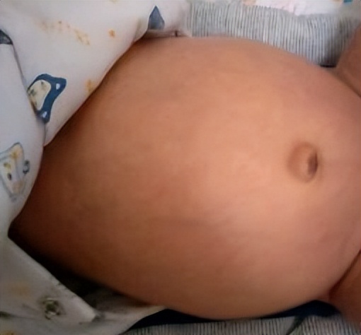 宝宝肚子像气球一样鼓鼓的,婴儿肚子很鼓像气球怎么办