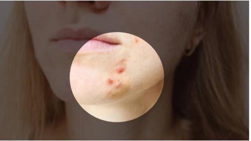 痘痘反复长痘印消不掉怎么办,3到4年青春痘反反复复用什么药好