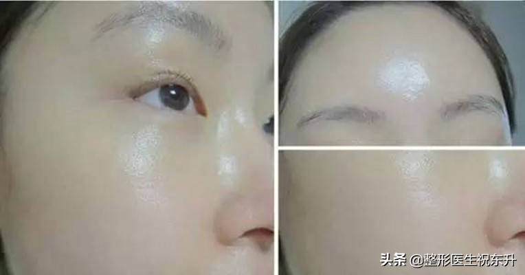 关于水光针的知识解析,水光针的十问十答