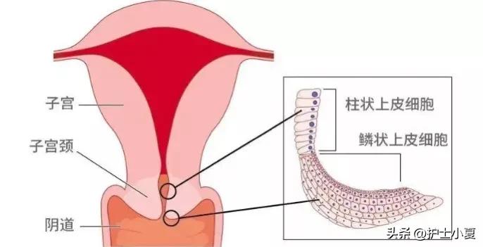 绝经后宫颈鳞状上皮萎缩是啥意思,绝经后子宫内膜单纯增生治疗