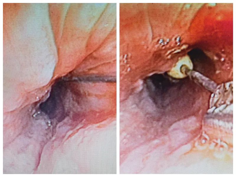 西安市北方医院:患者支气管里发现注射器针头，医生巧施异物钳顺利取出