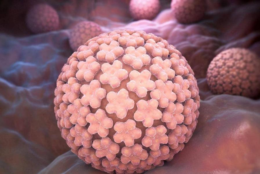 不论男女，身上长出这5种“瘊子”，或已感染HPV病毒！千万别轻视