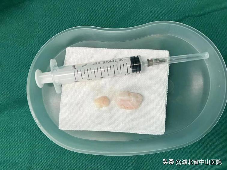 【中山医“声”】膝盖“卡壳”是怎么回事？原来是游离体在捣乱