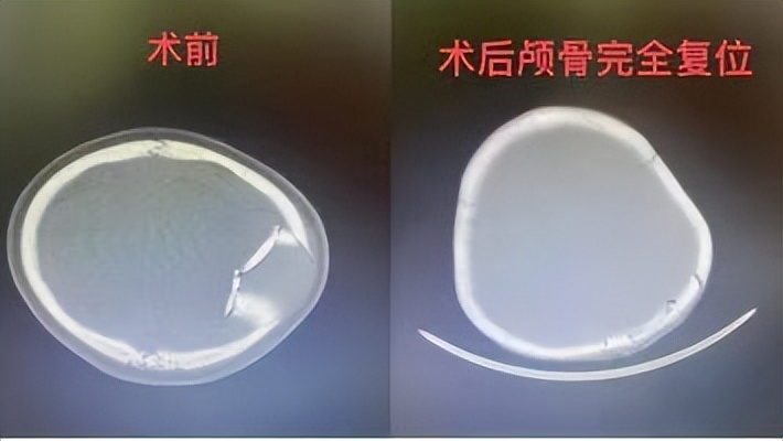 四川甘孜6.8级地震女孩牺牲,地震致1岁女童颅骨受伤
