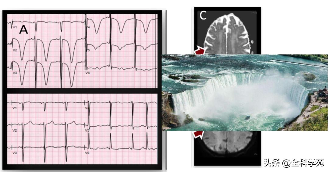 t波倒置三种常见原因,t波低平倒置有事吗