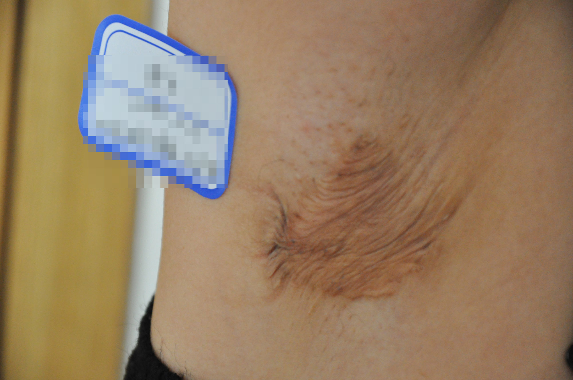 郑州第二中医院治疗疤痕能去除吗,郑州第二中医院皮肤科张子春