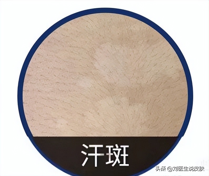 什么是白癜风和白斑有什么区别,是不是白癜风长在手上比较难治