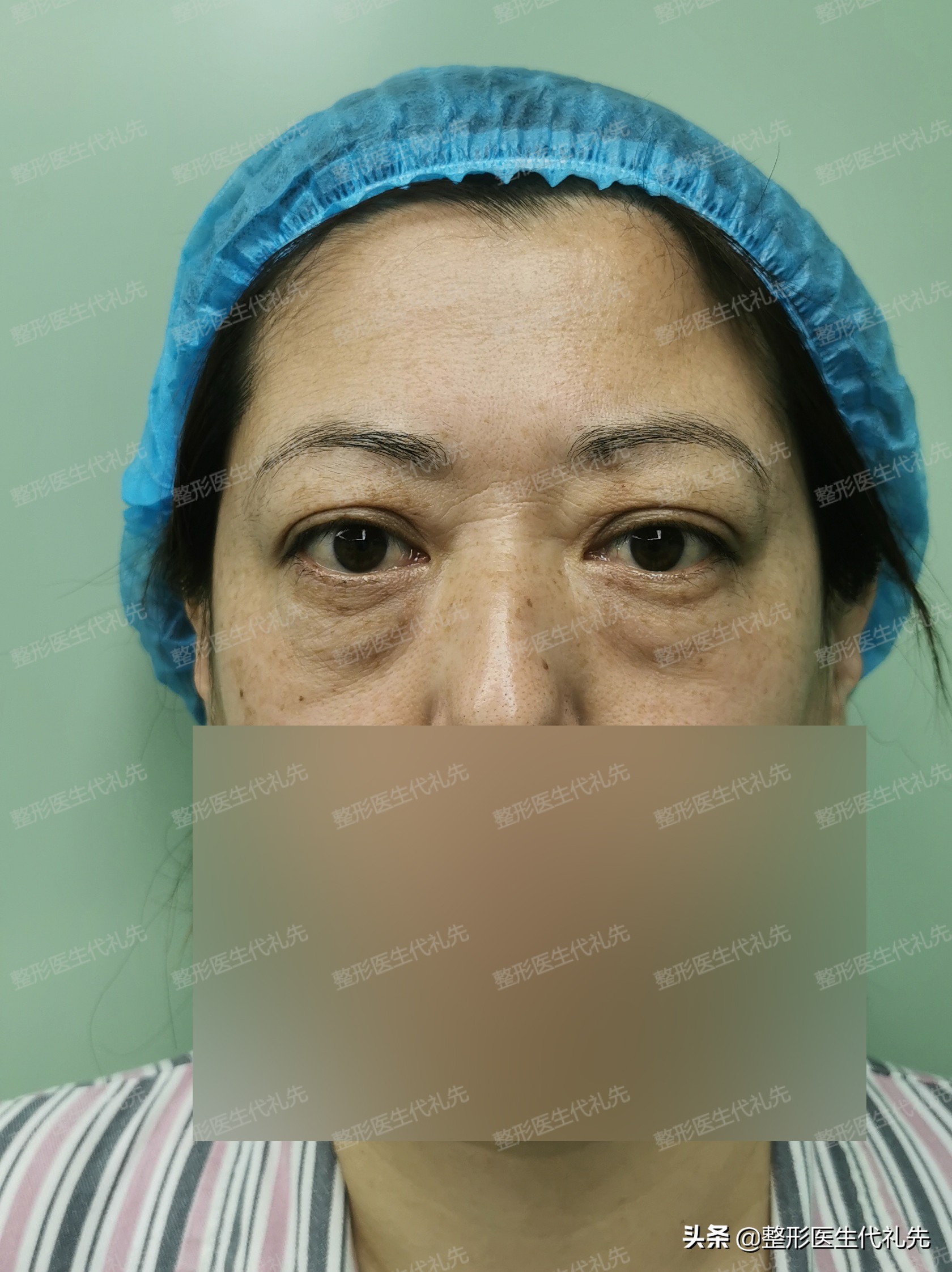 做提眉和外切眼袋恢复过程,提眉眼袋手术第9天