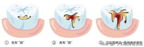 小心蛀牙,牙齿邻面龋坏轻微牙医说不用处理