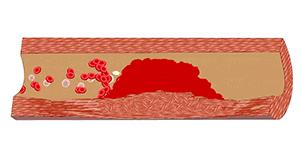 擤鼻涕千万别两个鼻子一起擤！这几天耳鼻喉科门诊里都是阳了后擤鼻涕擤出中耳炎的人“阳康”之后又有新烦恼