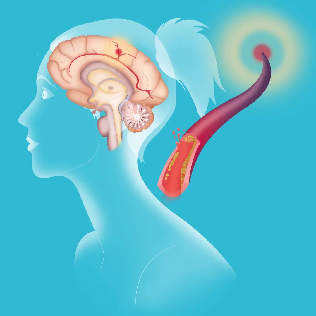 3天3例脑梗死！头晕、头痛、乏力..注意，别把“热中风”当中暑