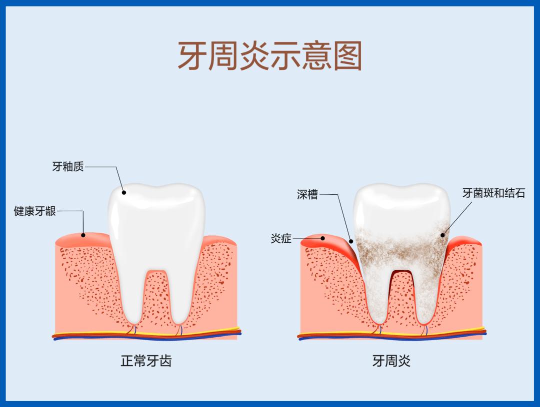 门牙缝隙很大影响颜值,门牙缝隙大影响说话清楚吗