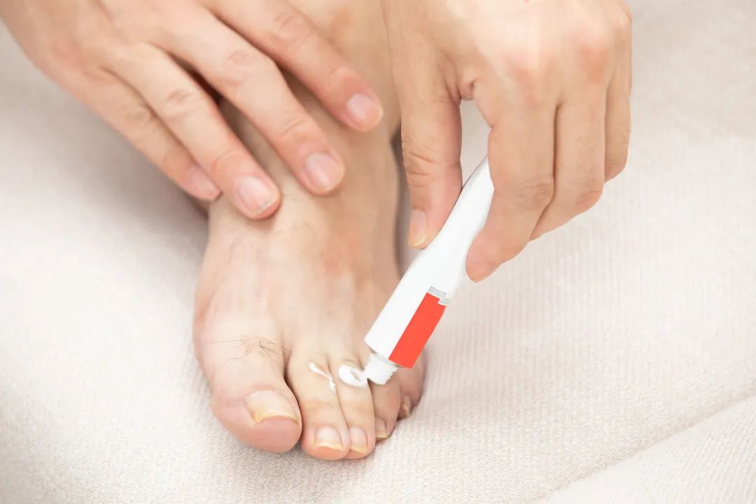 一到夏天脚气总复发怎么办呢,一到夏季脚气怎么消除