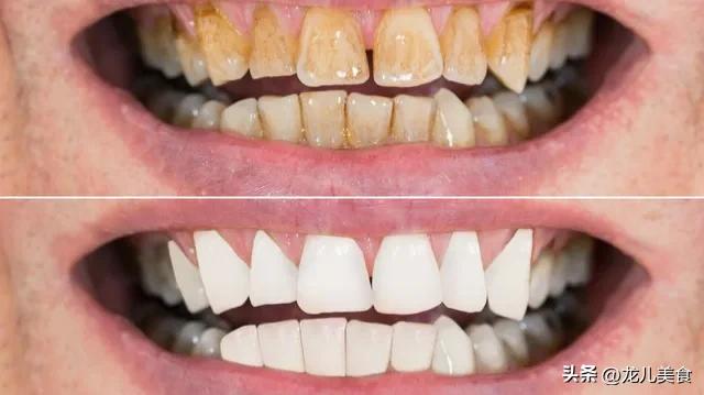 不经常刷牙牙齿黄洗牙管用吗,牙齿变白去黄不用牙膏