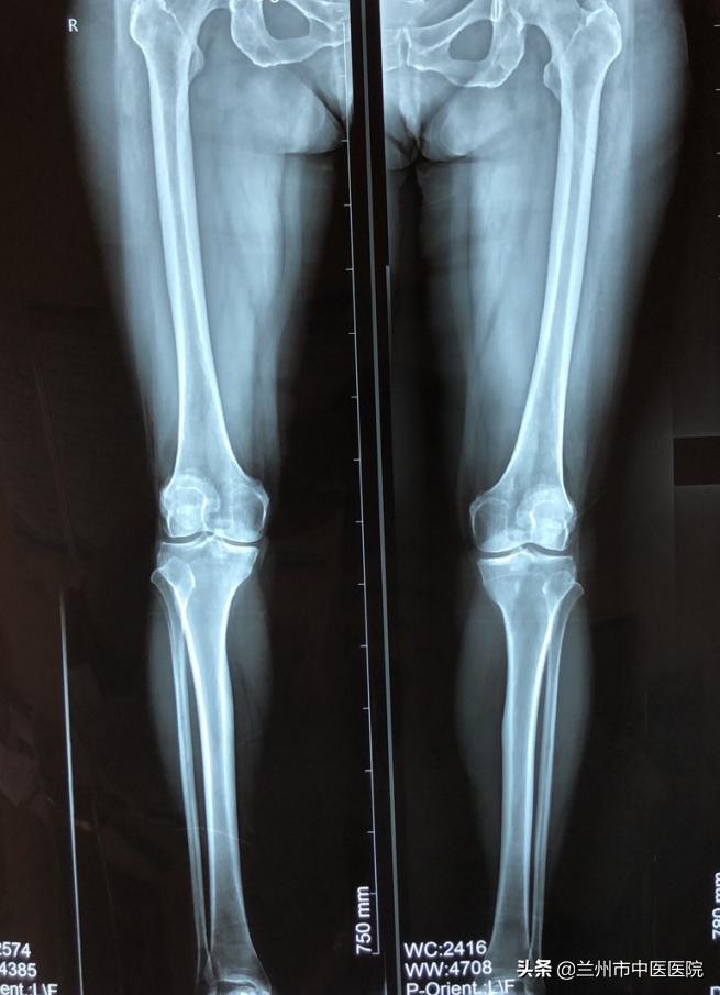 兰州市中医骨伤科医院官网,兰州市中医骨伤科医院的康复科
