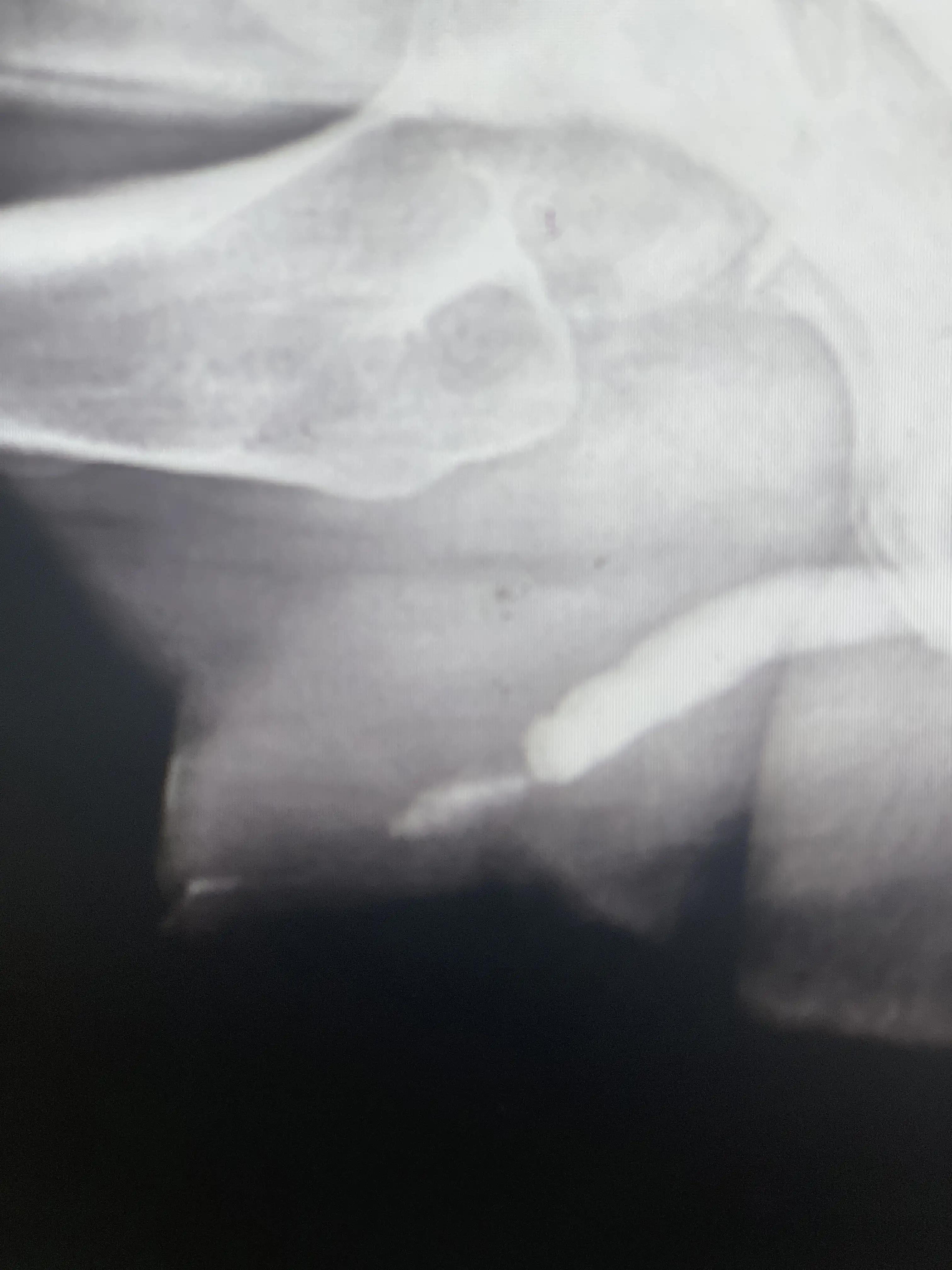 尿道狭窄修复术手术记录,治疗外伤性尿道狭窄专家