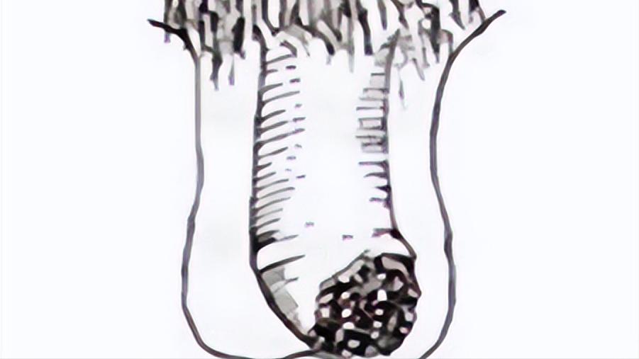 关于阴茎癌你知道多少？阴茎癌都要“一刀切”吗？建议男性们看看