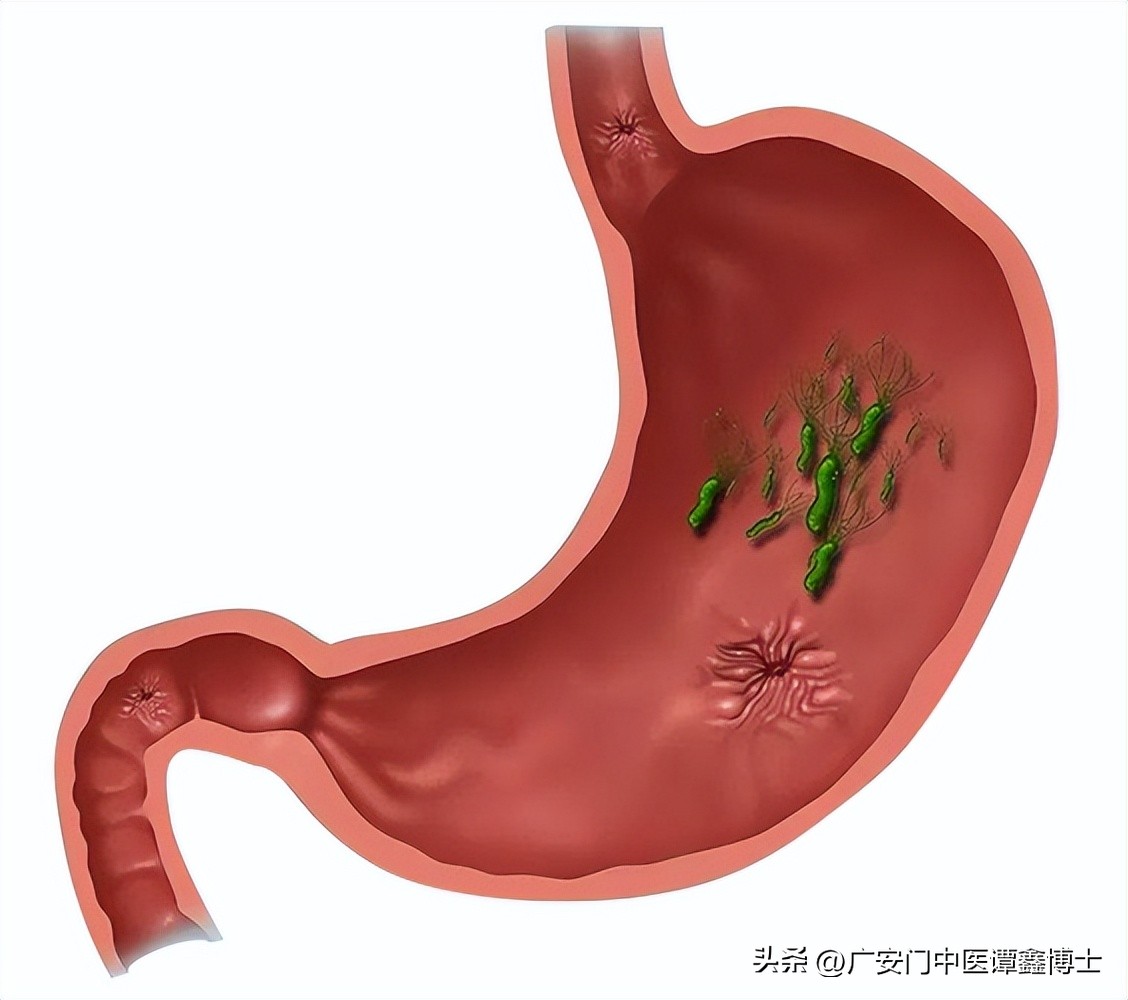 胃溃疡有可能转为胃癌吗,胃溃疡演变成癌症的几率多大