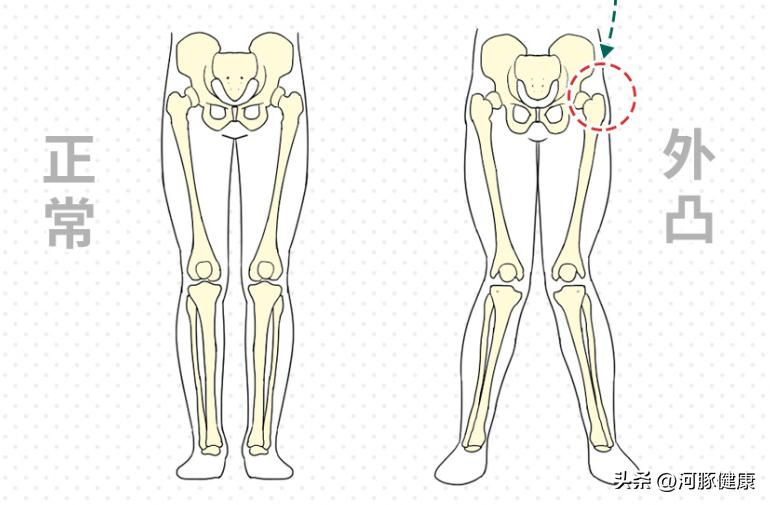为什么不胖但是大腿特别粗,人不胖大腿粗是什么原因造成的