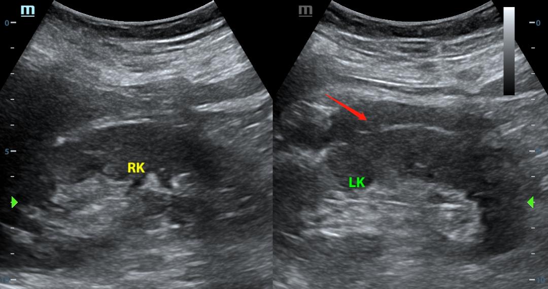 超声介入入门,手把手教你入门超声