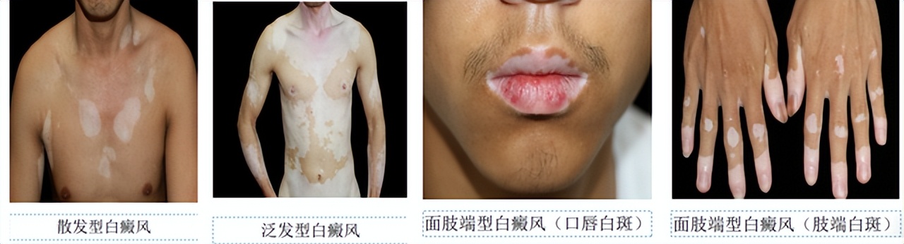 皮肤色素减退和白癜风有什么区别,白癜风是不是色素性皮肤病