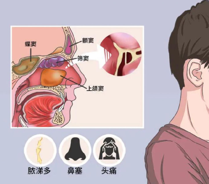 儿童鼻窦炎用药一般多久能好,儿童鼻窦炎抗生素的用法