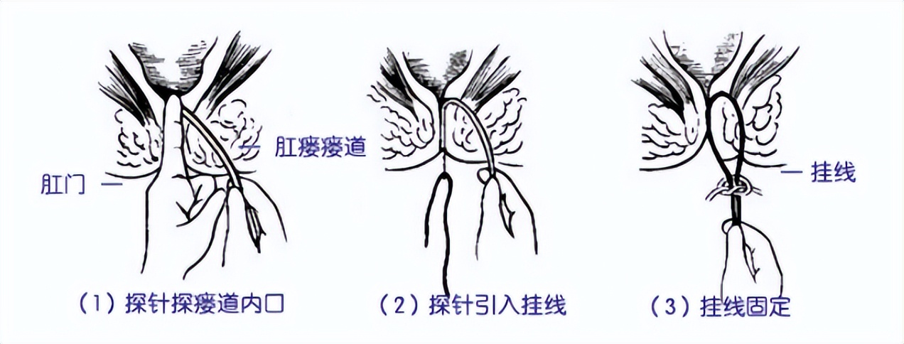 中医肛瘘的辨证论治,肛瘘中医和西医哪个好