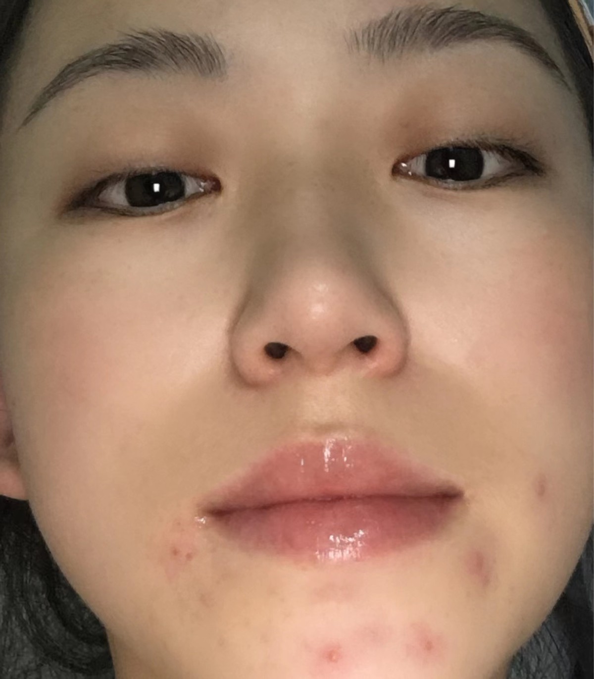 下巴总长痘痘粉刺怎么回事,姨妈之前下巴长痘痘怎么解决