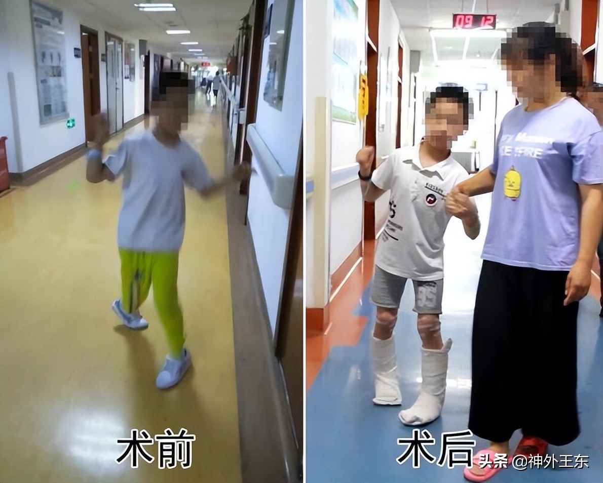 上海华山医院手术治疗脑瘫怎么样,脑瘫导致肢体畸形矫正手术