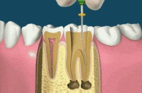 年底牙疼怎么办,春季牙疼是什么原因