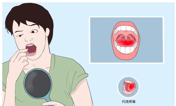 灼口综合征的舌头图片,舌头灼口综合征吃什么药
