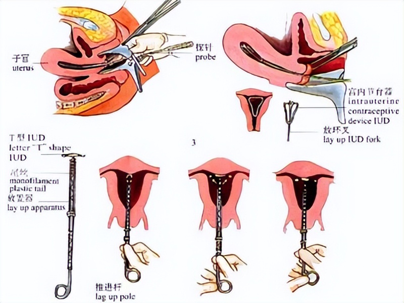 女人上环详细步骤,女性上环流程