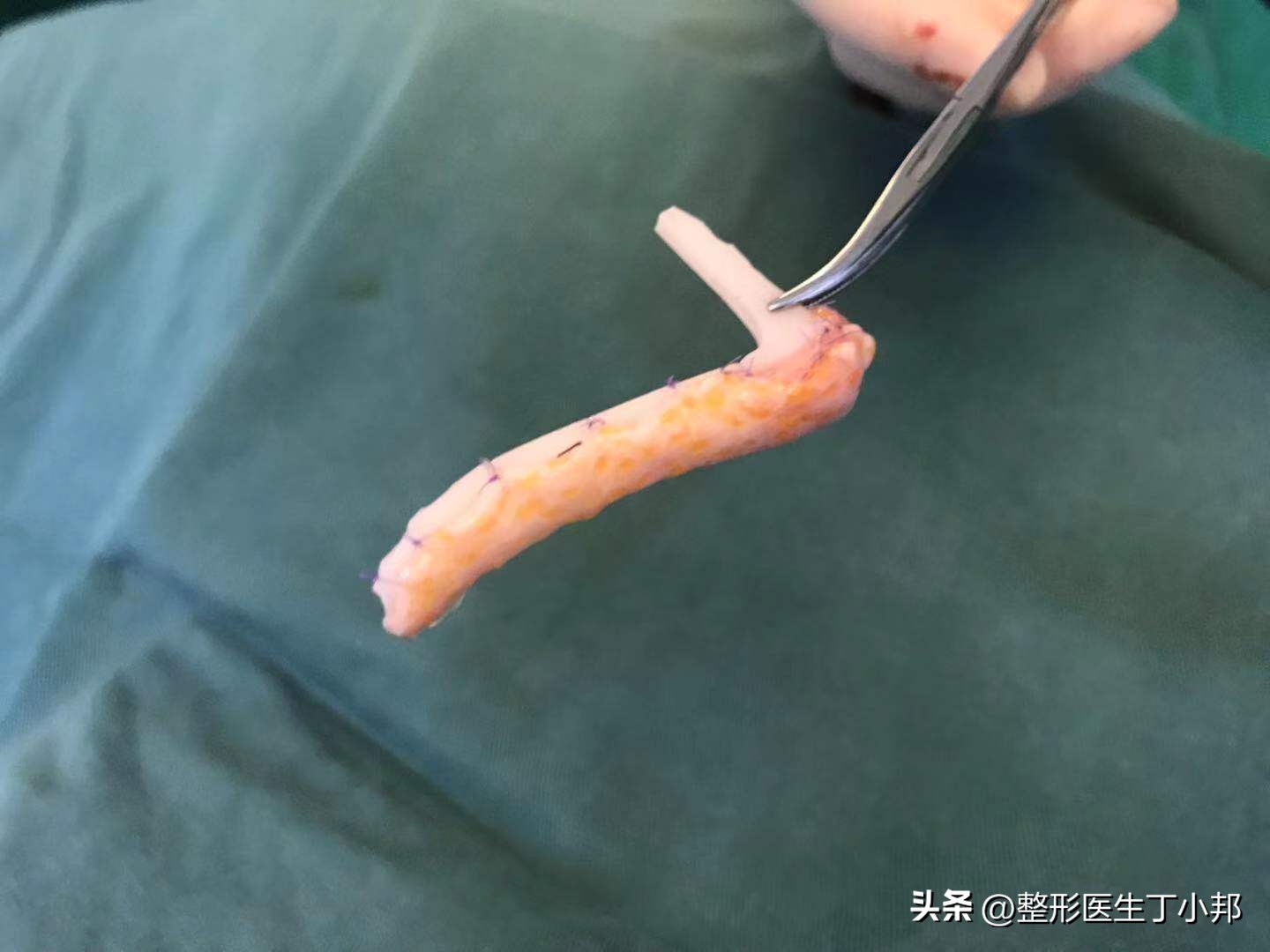 注射隆鼻材料取出难吗,打了玻尿酸填充鼻基底有异物感