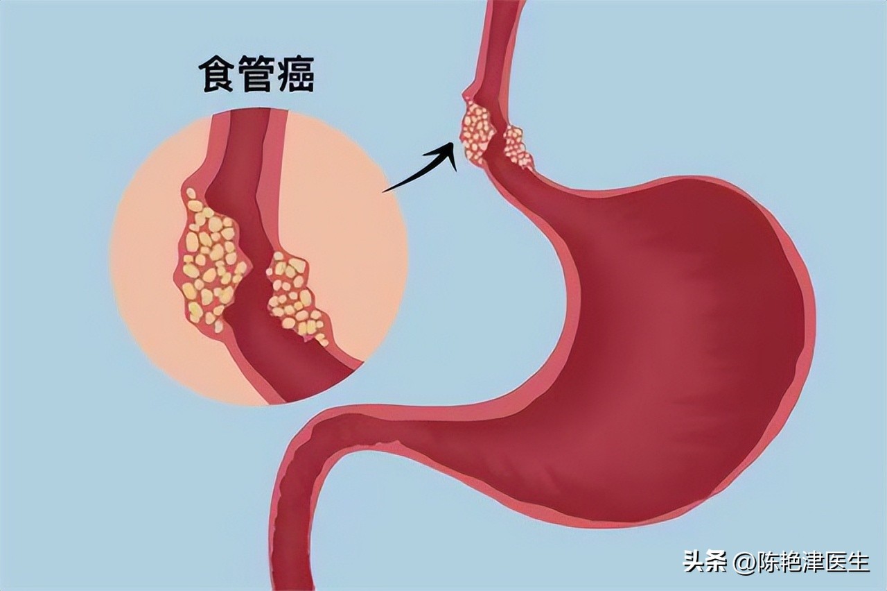咽炎查出食管癌,以为是慢性咽炎却是食管癌
