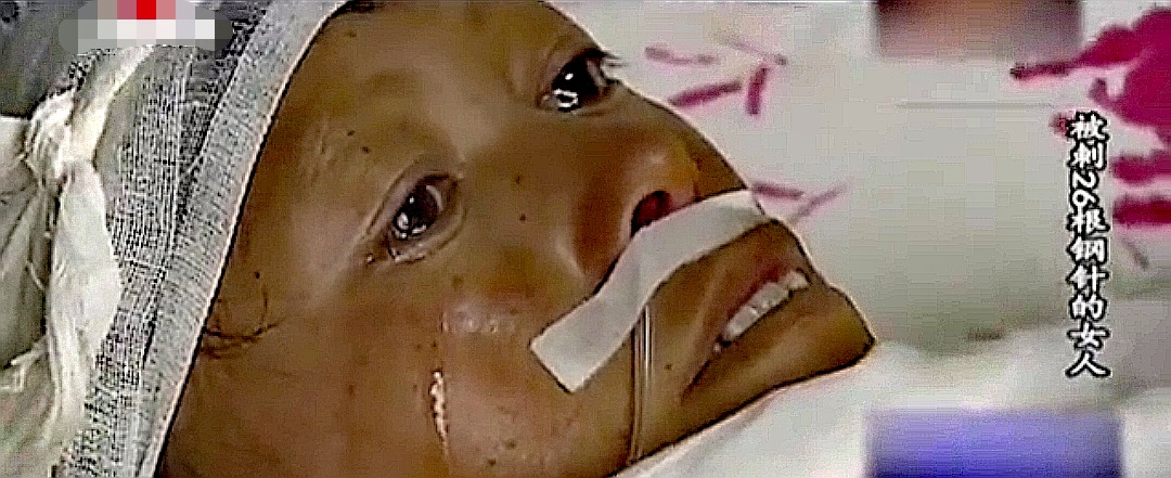 云南女子体内26根绣花针凶手是谁,云南女子缝衣针