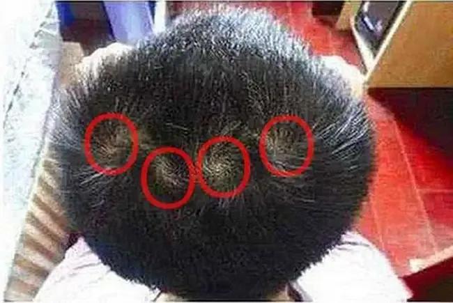 头顶漩涡处头发稀少怎么办,15岁头顶漩涡处头发稀少