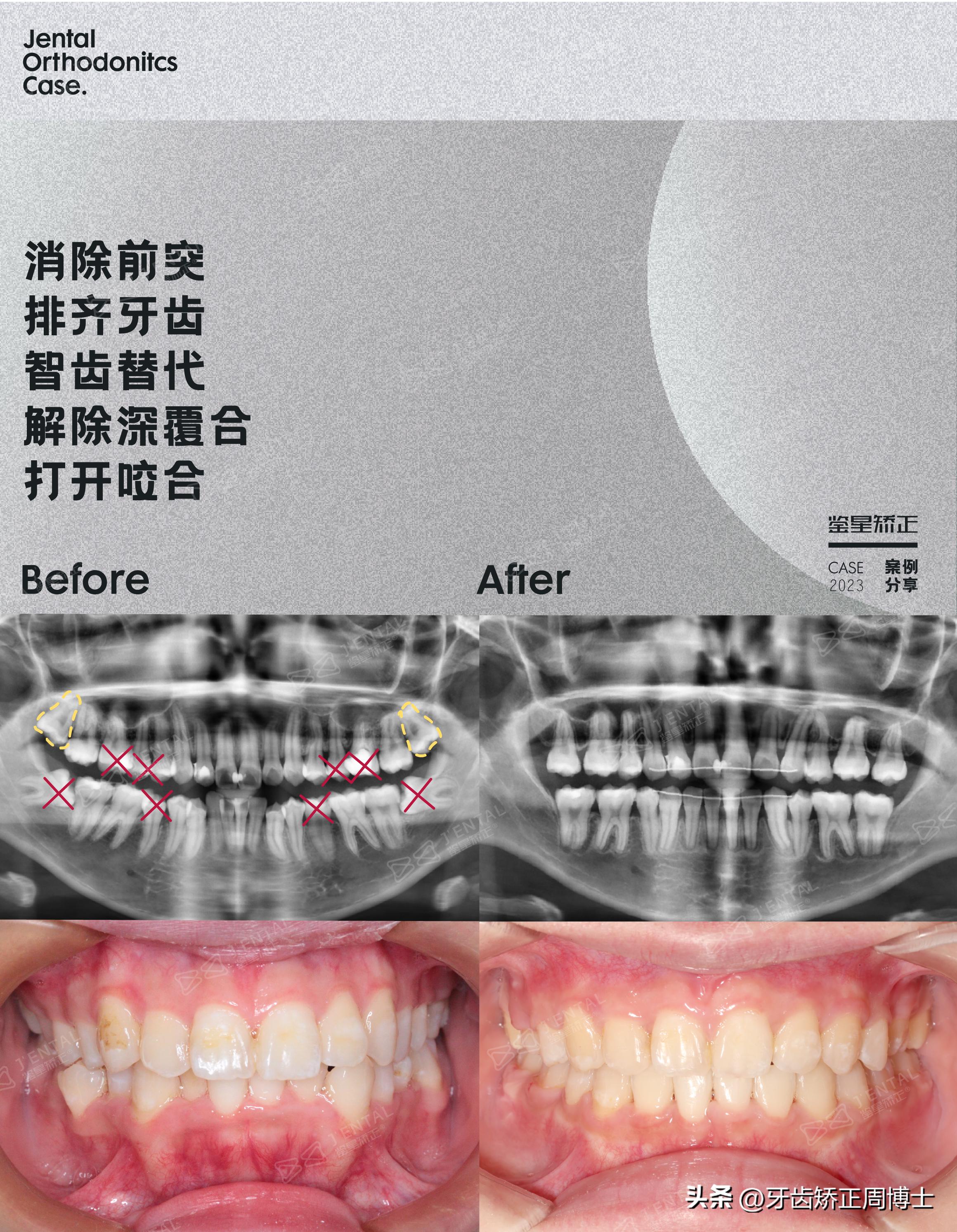 龅牙骨钉矫正演示,骨性龅牙打骨钉前后对比