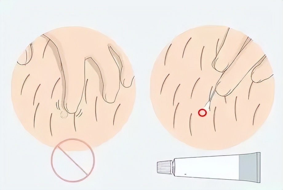 下身长痘痘怎么才知道是性病了,阴茎上起了一个痘痘是性病吗
