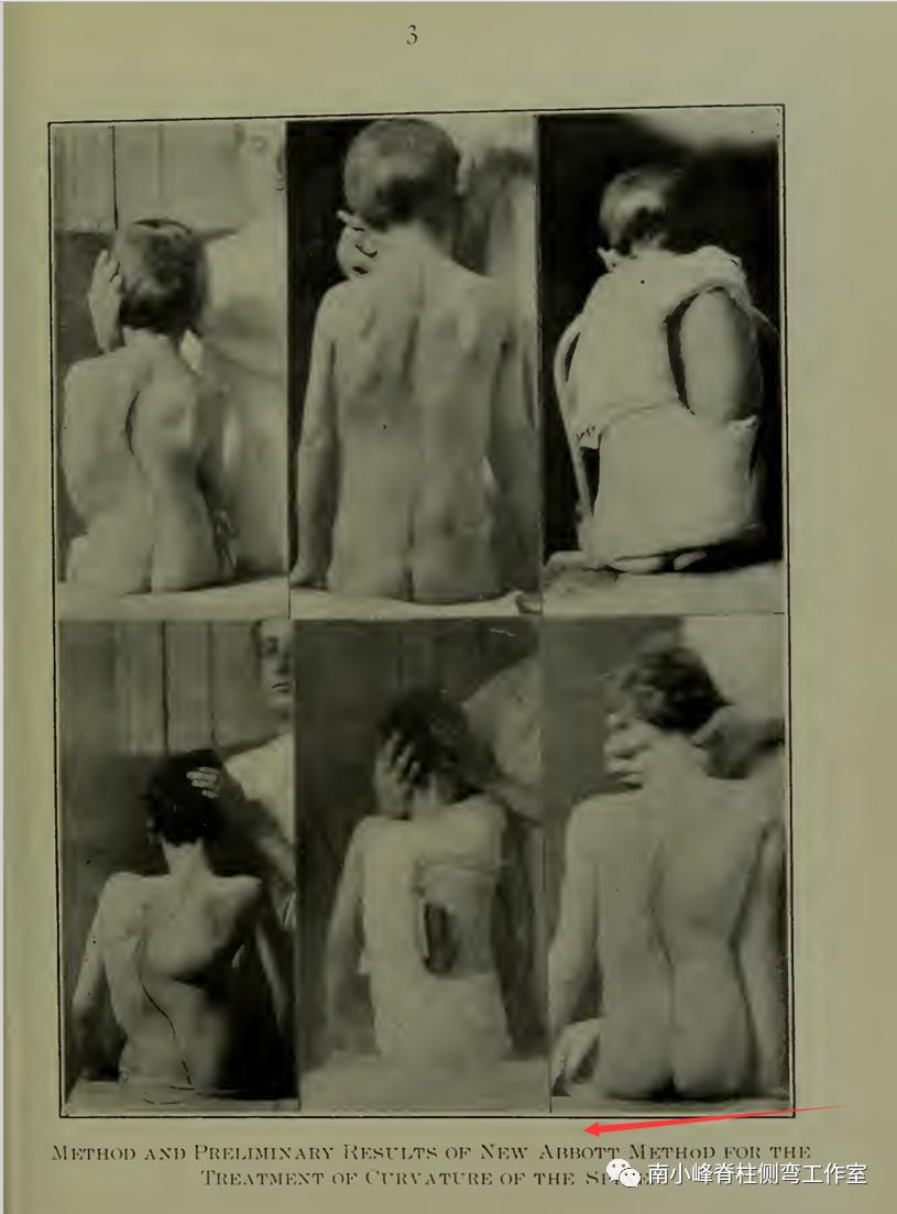 gbw硬质支具矫正脊柱侧弯,gbw支具案例