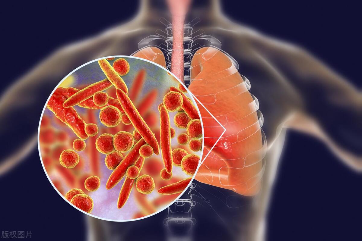 帕金森综合征的并发症的表现,帕金森装起搏器还会有并发症