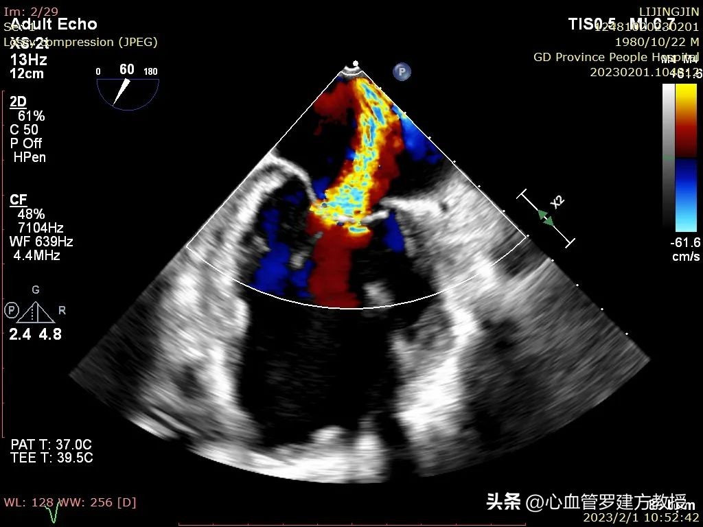 二尖瓣狭窄病例分享,二尖瓣病理生理及治疗方法