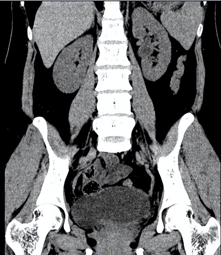 达芬奇系列|哈医大一院泌尿外科王春阳机器人团队巧用膀胱肌瓣重建输尿管助女性解除阴道漏尿困扰