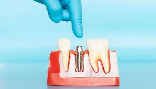 珠海口腔医院种植牙价格表图,珠海口腔医院种植牙价格表