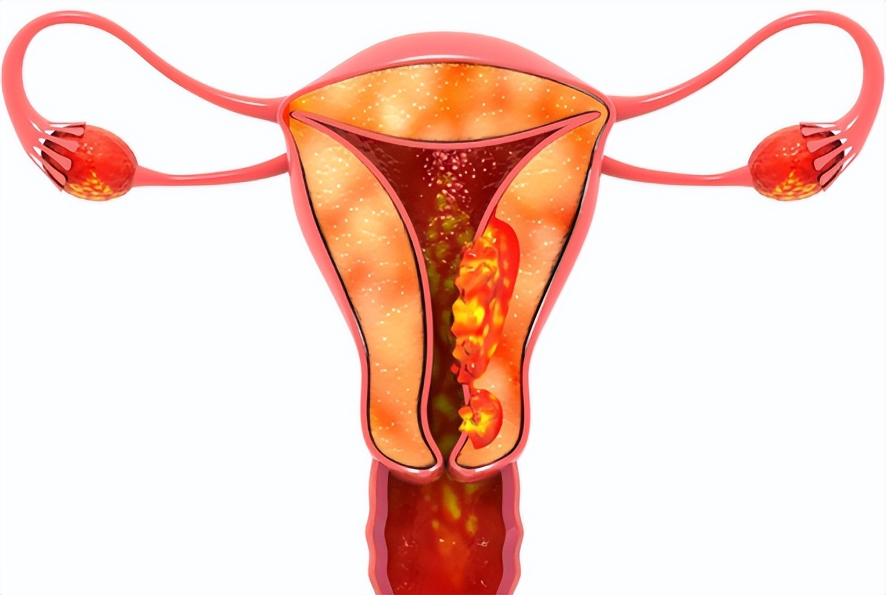 日本为什么不建议打hpv疫苗,日本为什么不打hpv疫苗