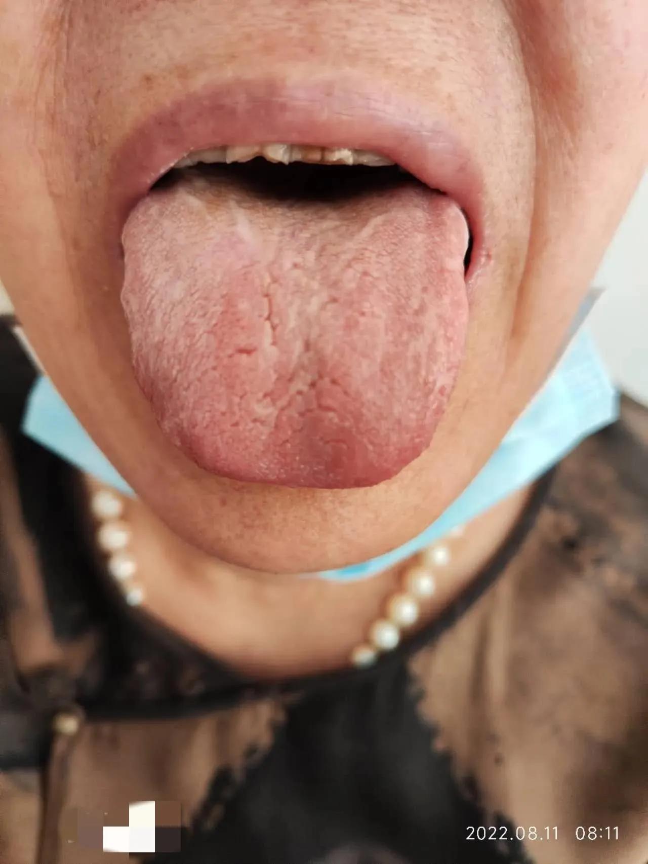 干燥综合征吃中药多久可以控制,干燥综合征喝中药可以治愈吗