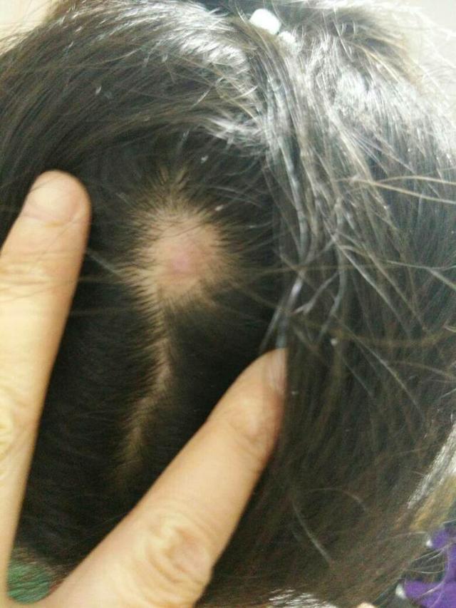 头皮总长小疙瘩和脓包怎么治疗,如何改善头皮长脓包和疙瘩的问题