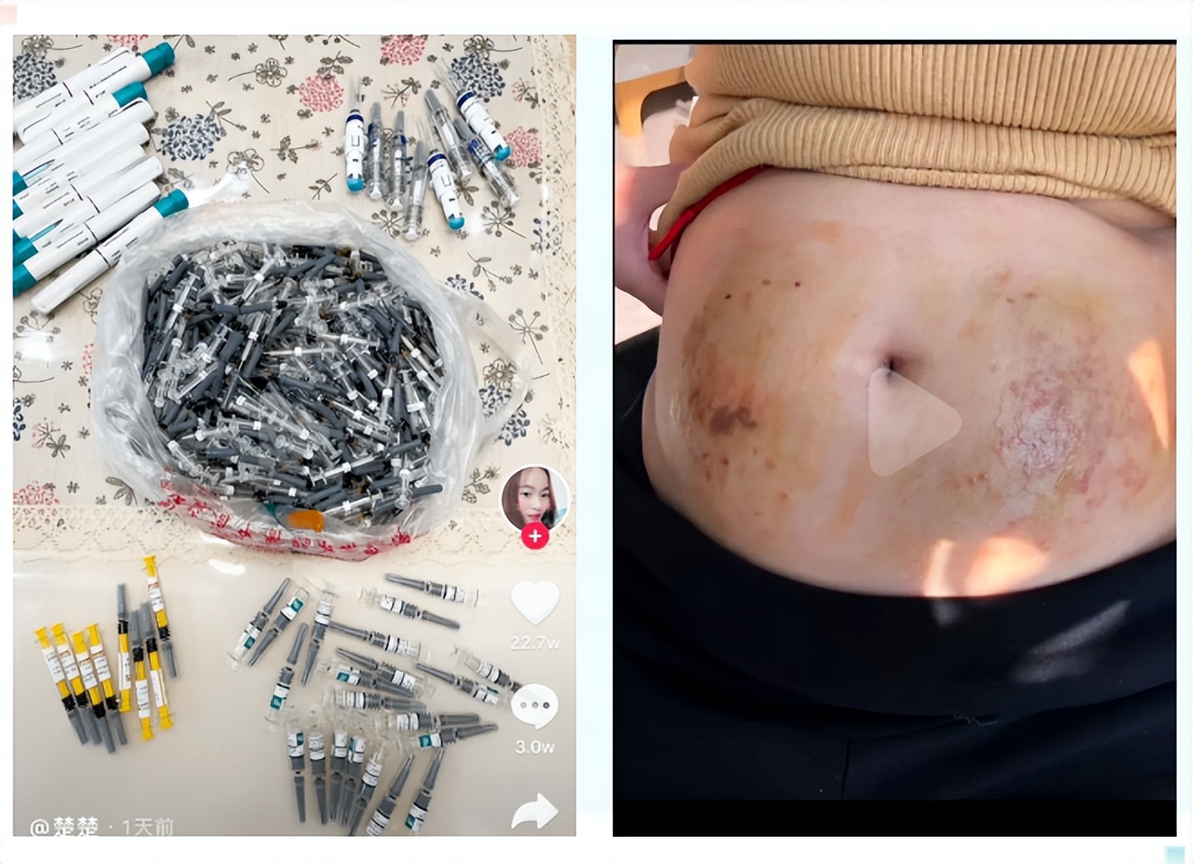 经历26次胎停,经历26次流产37岁怀孕成功