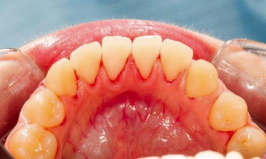 牙龈出血也是病，待到松动可要命,来听听专家建议